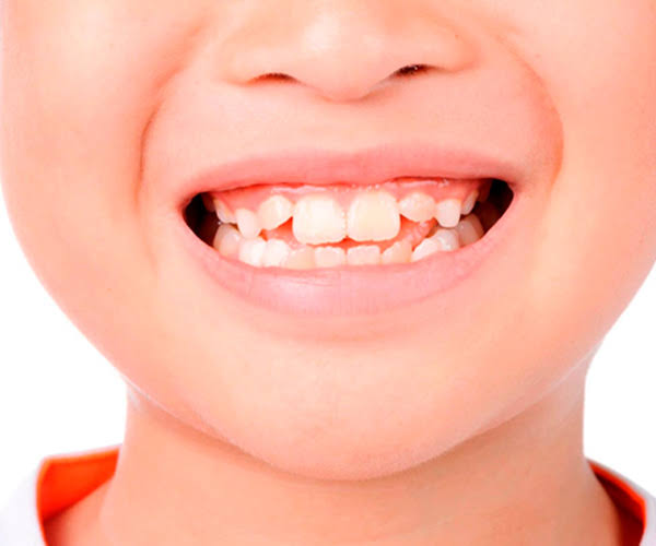 Solución a dientes amarillos por especialistas en Odontologia Pediatrica