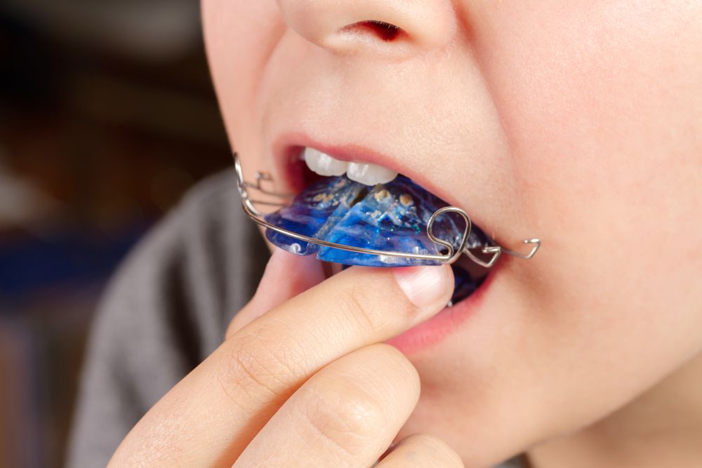 ¿Qué signos nos pueden indicar que un niño necesita ortodoncia?